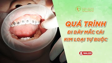 Niềng răng mắc cài tự buộc có ưu điểm gì? KH. Vũ Thị Thương