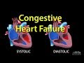 Congestive Heart Failure: Left-sided vs Right-sided, Systolic vs Diastolic, Animation.