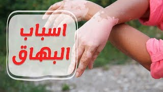 اسباب الاصابة بمرض البهاق وطرق الوقاية والعلاج منه