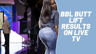 What Is Brazilian Butt Lift Surgery | Innovations Medical | Dallas, Tx