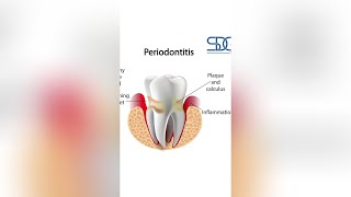 Types Of Treatment For Periodontal Disease