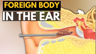 Foreign Body in the Ear, , Signs and Symptoms,Diagnosis and Treatment.