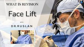 30. Lifting facial de revisión: Corrigiendo los resultados de un estiramiento facial previo