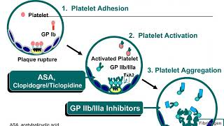 Aspirin For The Prevention Of Cardiovascular Disease -Mubashar A Choudry Md
