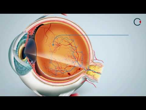 Vídeo: Angiopatia Hipertensiva Da Retina De Ambos Os Olhos: O Que é, Sinais