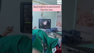 Oocyte pick up - Egg Retrieval procedure in IVF Treatment.