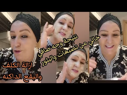 علاج البشرة الجافة والكلف لي عندو نمش تصبغات الوجه البقع الداكنة الحل نهائي ونتيجة كتبان من ثالث يوم  علاج البشرة الجافة والكلف لي عندو نمش تصبغات الوجه البقع الداكنة الحل نهائي ونتيجة كتبان من ثالث يوم