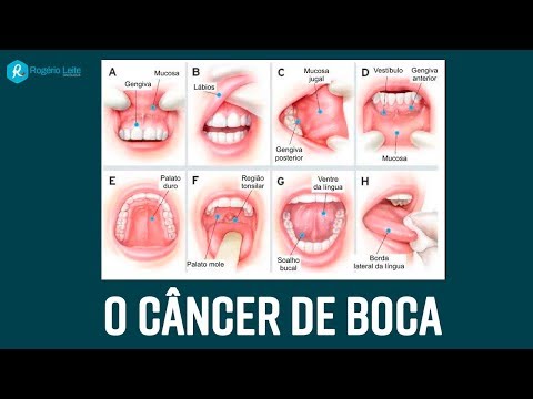 O que é o Câncer de boca [076] Dr. Rogério Leite