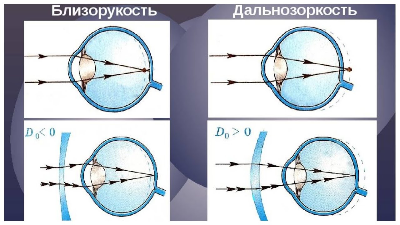 Фактическое зрение. Дефекты зрения близорукость и дальнозоркость. Какими линзами корректируется близорукость и дальнозоркость. Коррекция линзами дефектов зрения. Линзы для коррекции миопии (близорукости).