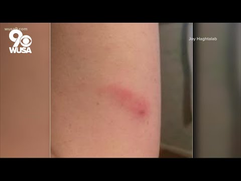 How to get relief from Oak Leaf Itch Mite bites