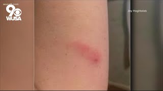 How to get relief from Oak Leaf Itch Mite bites How Do You Stop Mites From Biting Me