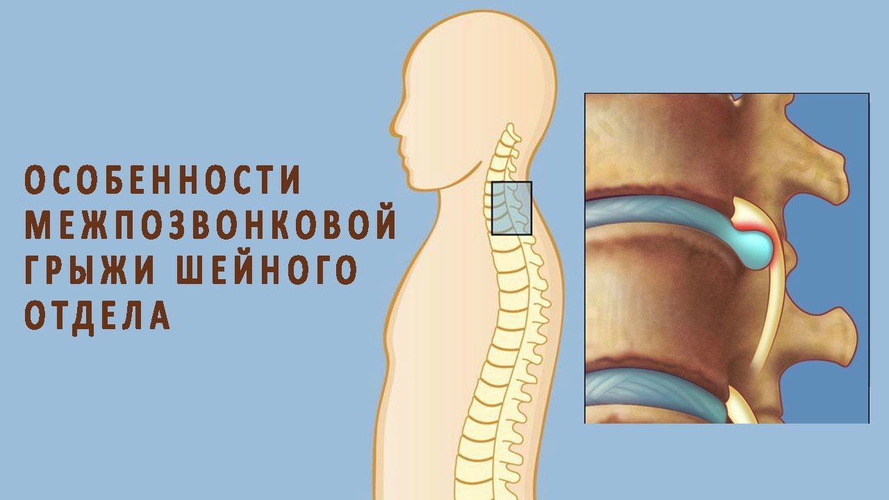 Грыжи шейного отдела позвоночника лечение без операции