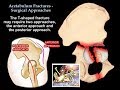 Acetabulum Fractures Surgical Approaches - Everything You Need To Know - Dr. Nabil Ebraheim