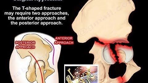 Acetabulum Fractures Surgical Approaches - Everything You Need To Know - Dr. Nabil Ebraheim