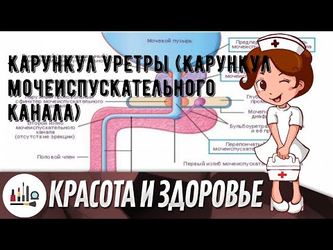 Карункул уретры (Карункул мочеиспускательного канала)