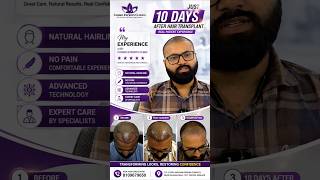 10 Days Of Hair Transplant?? #shorts