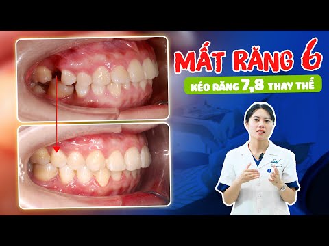 Tận Dụng Răng 7, 8 Thay Thế Răng 6 Có Khả Thi Với Mọi Trường Hợp? Nha Khoa Lạc Việt Intech