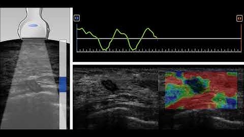 Strain Elastography