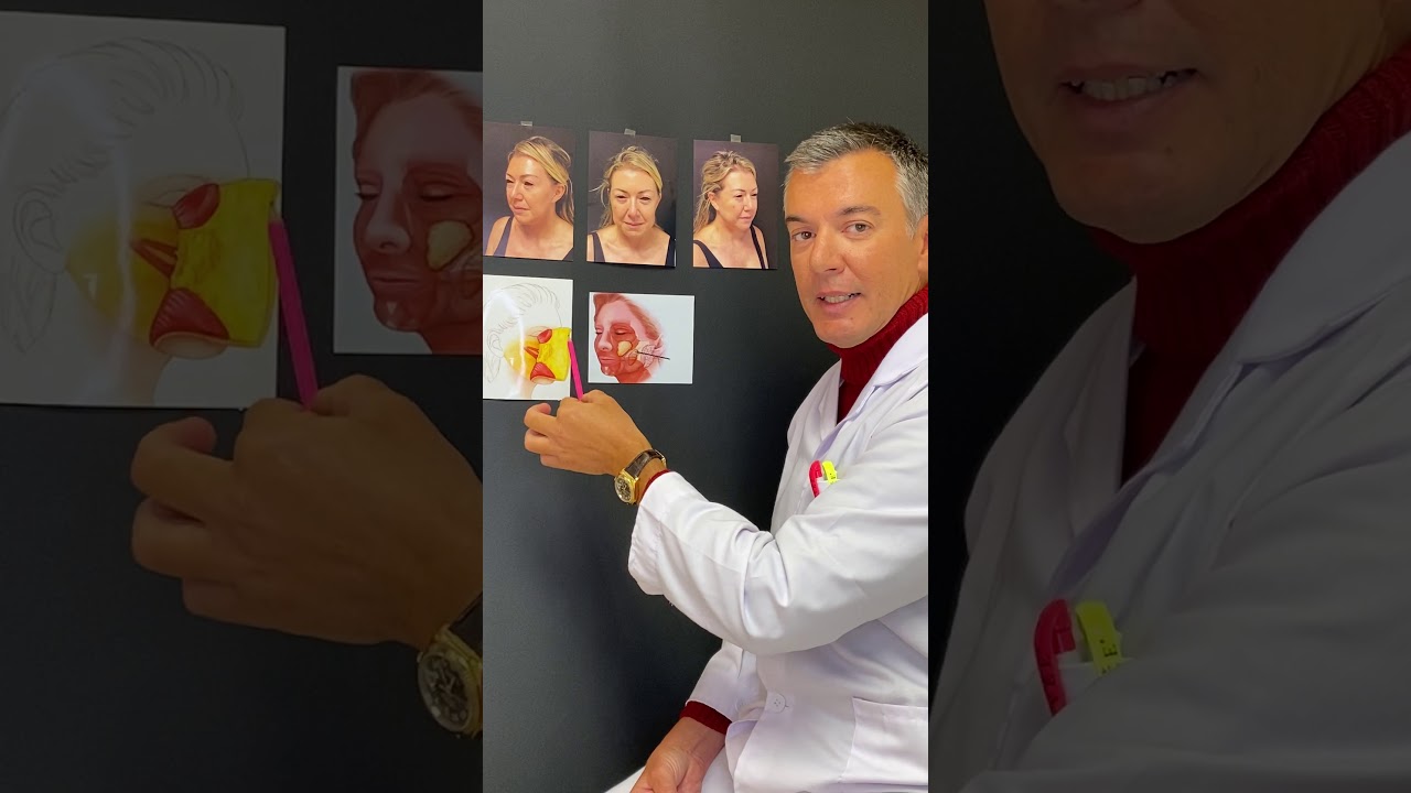 Lifting del Viso - Dott. Antonio Distefano