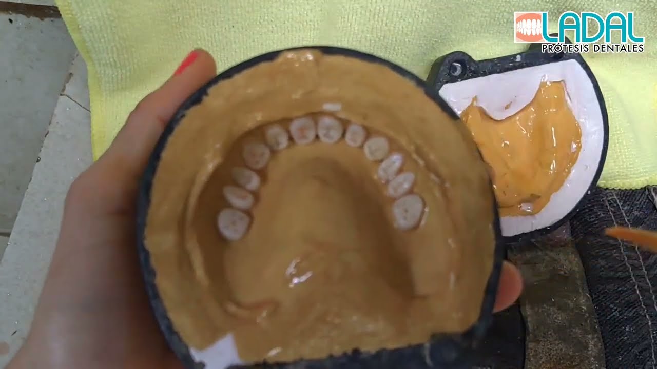 Prótesis dental Provisional acrílica paso a paso