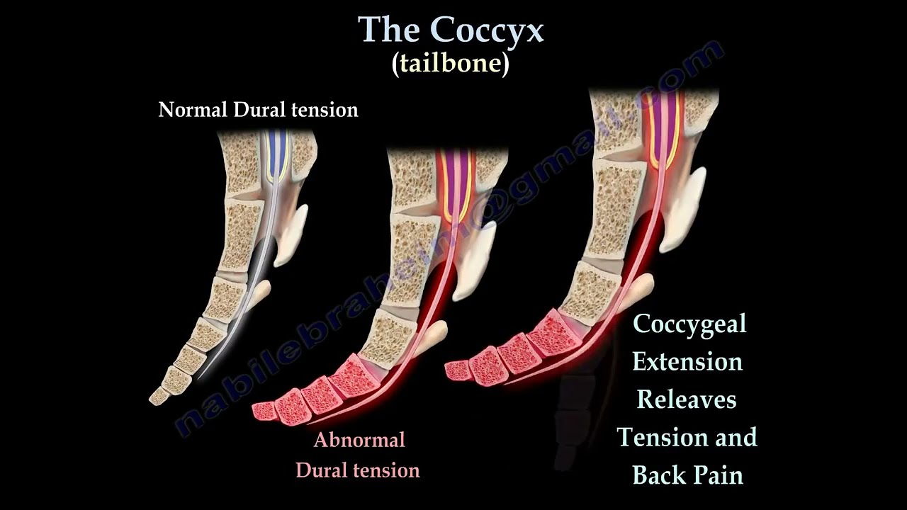 Coccydynia (Tailbone Pain)