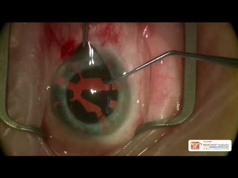 Morcher Type 50 Aniridia Ring Series Implantation