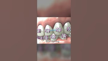 How a coil spring opens space in between teeth !! #braces #orthodontics #dentist #teeth