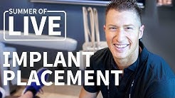 Guided Dental Implant Placement - LIVE Treatment 