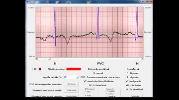ECG signal processing