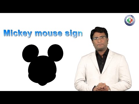 MICKEY MOUSE SIGN - Radiology by Dr Khaleel