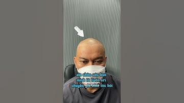 Xăm tóc hói cho nam, hói chữ M, sau xăm tóc và sự thay đổi