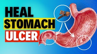 3 Ways to Cure Stomach ulcer fast with cloves