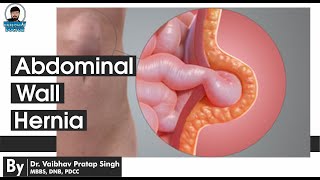 Abdominal Wall Hernia Explained with Dr. Vaibhav Pratap Singh