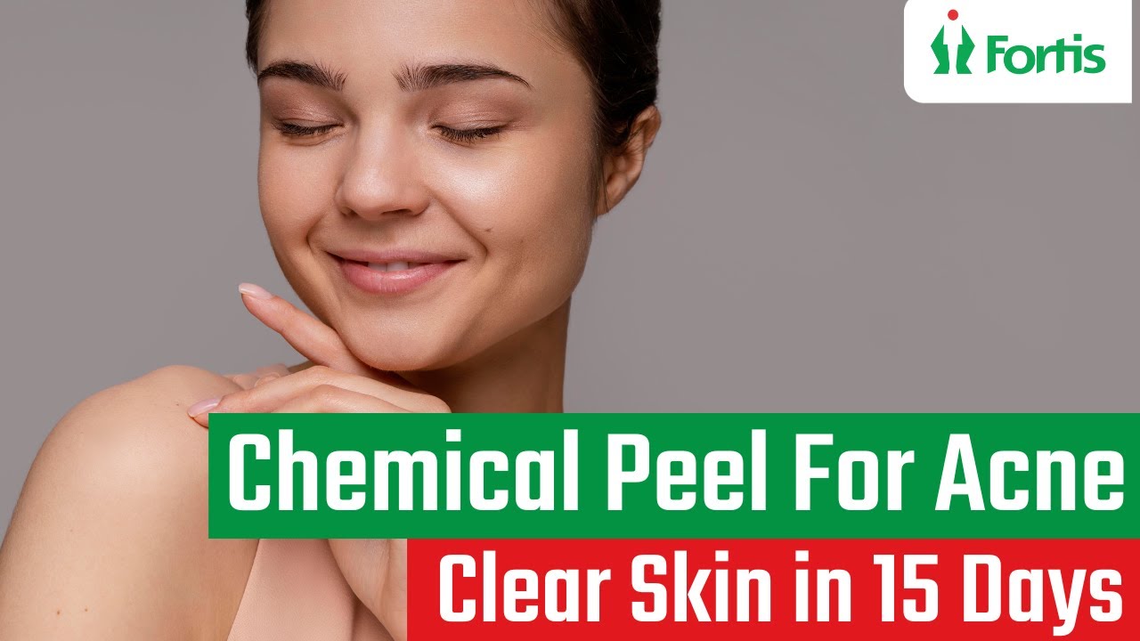 Part 2Chemical Peel Skin Peeling TreatmentChemical Peel For Acne