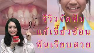 จัดฟันครบ 90 วัน | วิวัฒนาการ การจัดฟันใน 3 เดือนกับฟัน 1 ซี่ที่มีปัญหา | Archii |