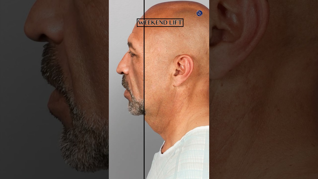 Male Weekend Lift Results| 3 Months Post-Op| Before and After