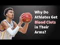 Arm DVTs in Athletes: Thoracic Outlet Syndrome