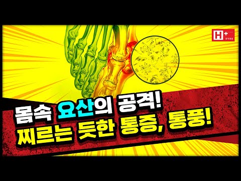 몸속 요산의 공격! 통풍
