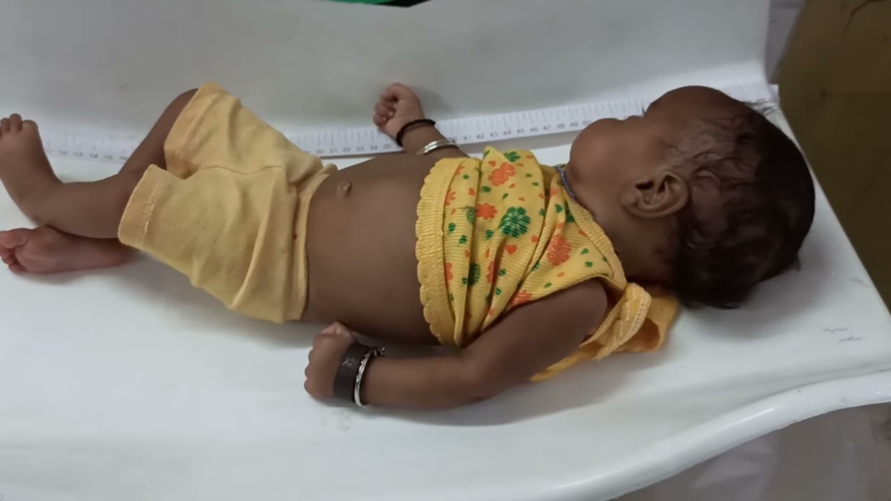 Complex partial seizure involoving left side of body