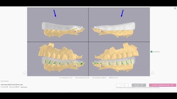 3Shape Automate: Nightguard Lowers and QC Images