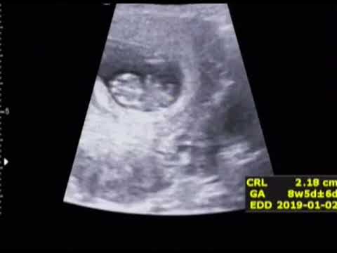 임신초기 동영상 ㅡ7주정도