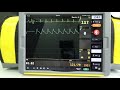 1.除細動エネルギー充電から, ショック　2. 除細動エネルギー充電から, 中止│REALITi 患者シナリオ・シミュレーター