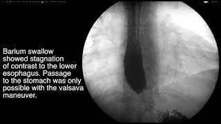 POEM for Achalasia in the setting of fibrosis