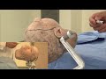 Skull Clamp Placement: Pterional Craniotomy-Incision (Preview)