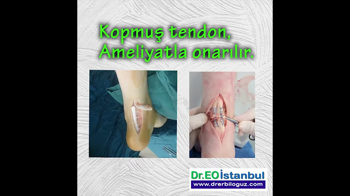 AŞİL TENDON KOPMASI