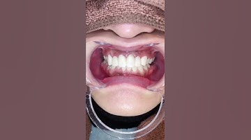 歯茎のラインも整います！歯肉整形術併用セラミック矯正！！