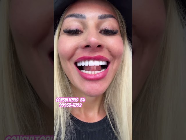 SORRISO PORCELANA 🤩