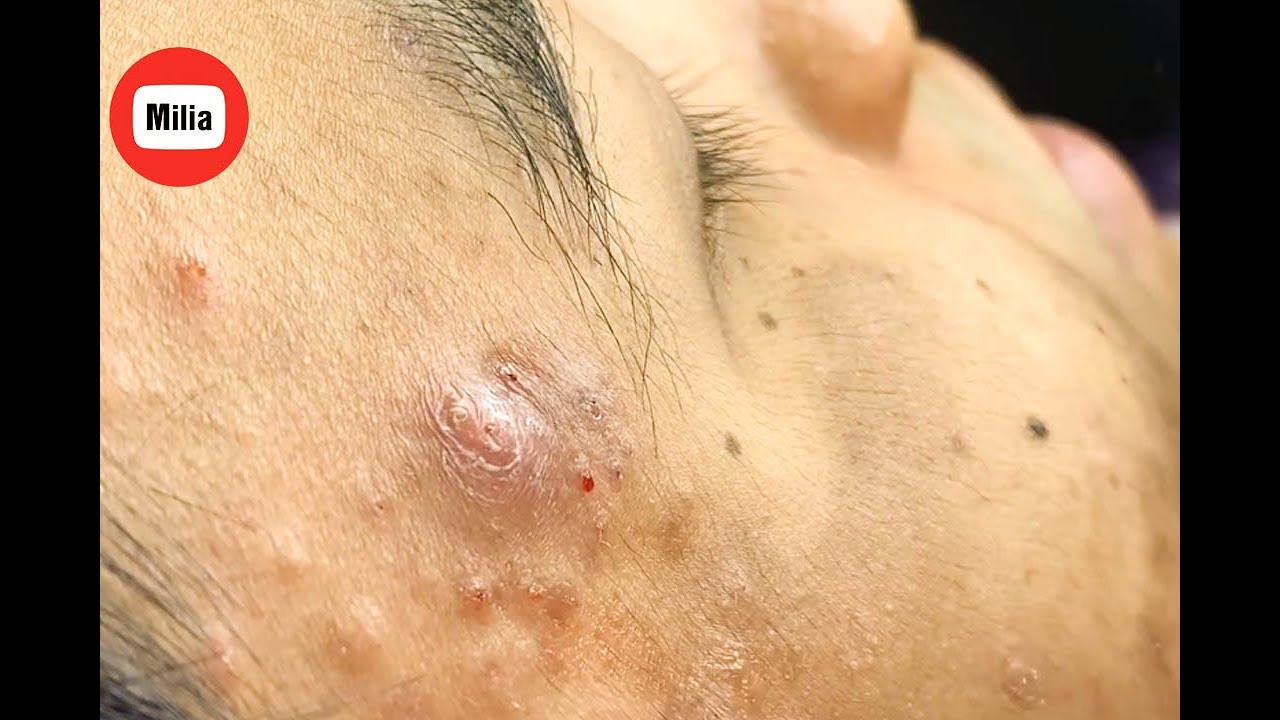 [Milia] Big acne removal ( pressed acne, clogged acne, attached to