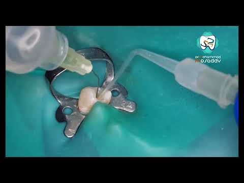 بروتوكول الارواء و التنشيط لهيبو كلوريد الصويديوم Irrgation And Activation 