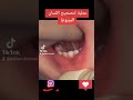 عملية لتصحيح اللسان المربوط اللسان المربوط Tongue Tie Babies Doctora Babies Doctora 